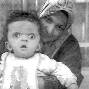 Hiroshima Birth Defects